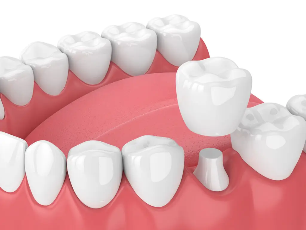 Dental Crowns vs Fillings: Which Does a Damaged Tooth Need?